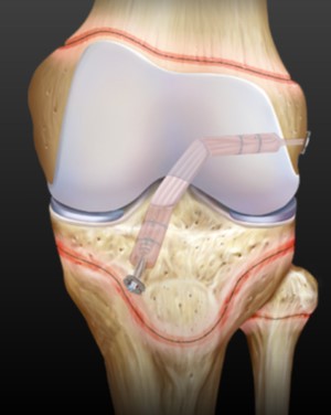 ligamento